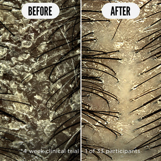 Paquete de inicio para cuero cabelludo sensible 